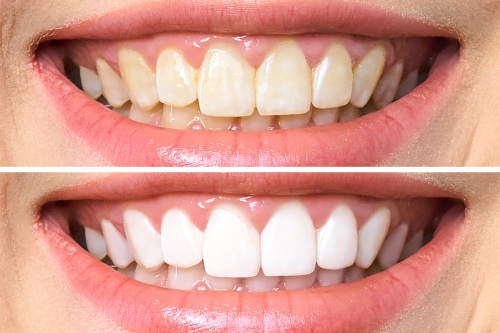 Teeth Whitening in Wayne County, NY | Cosmetic Dentistry in Clyde