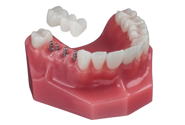 Dental Bridges in Wayne County, NY | Implant Bridge Solutions