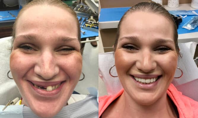 Before-After-Mini-Dental-Implants