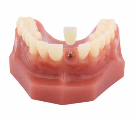 Dental Crowns in Wayne County, NY