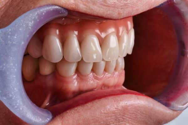 Dentures in Wayne County, NY Mini Implant Dentures in Clyde