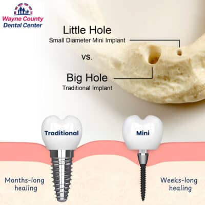 Mini-Dental-Implants-vs-Regular-Dental-Implants