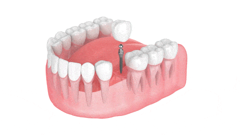 Dental Implants in Wayne County, NY