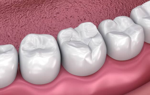 Tooth-Colored Fillings in Wayne County, NY | Dentist in Clyde, NY